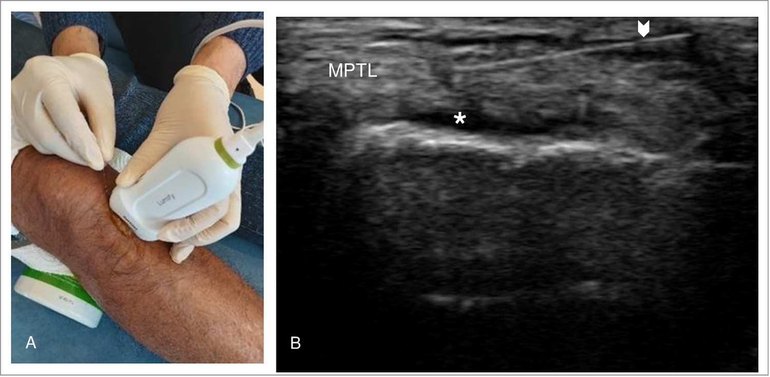 Philips Lumify L12-4 in clinical use in Pang et al.'s published study, with an accompanying ultrasound panel